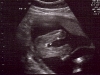 It\'s a girl! (20 weeks)