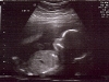 Baby B profile (20 weeks)