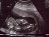It\'s A Boy! (20 weeks)