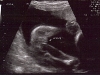 Another pic of my daughter\'s...umm...let\'s move on (24 weeks)